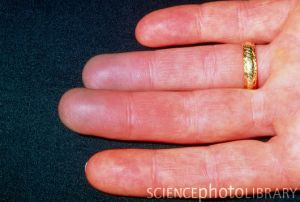 Raynaud's phenomenon seen on a woman's fingers